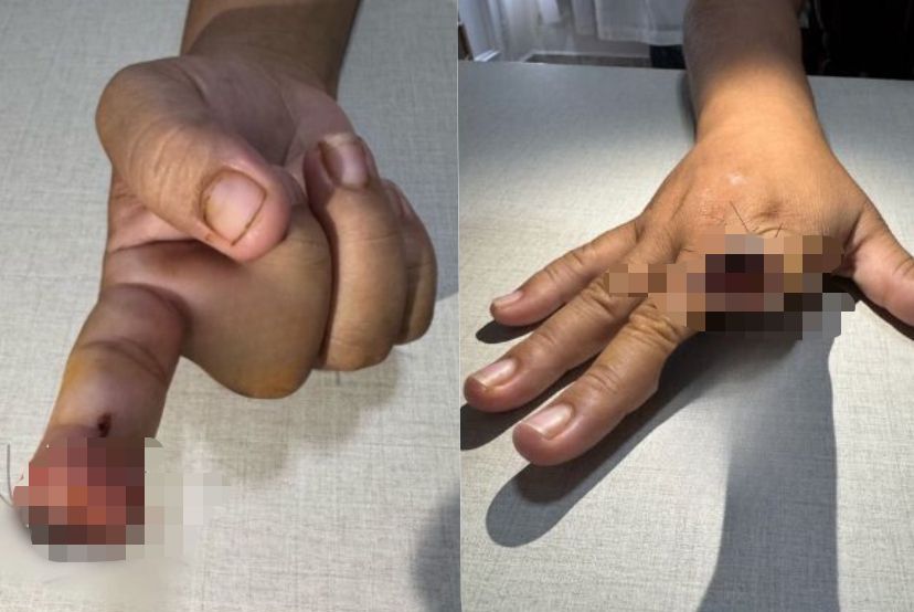 Homem arranca pedaço do dedo da namorada durante ataque de ciúmes em Manaus