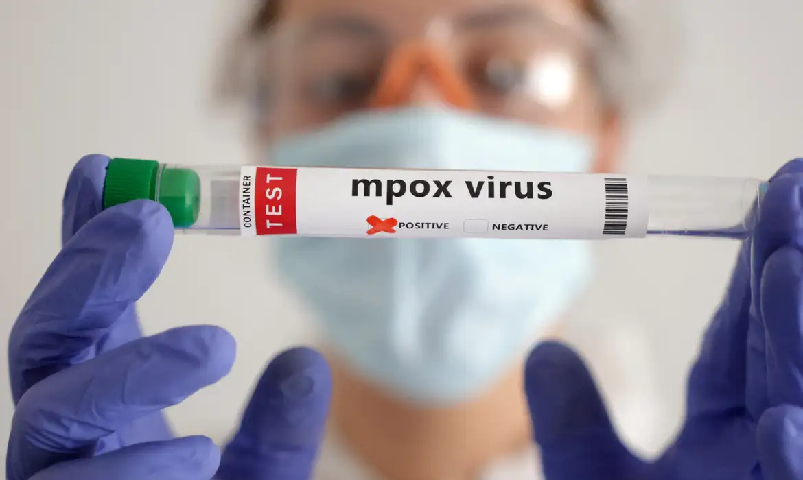 Número de casos de Mpox sobe para 35 no Amazonas