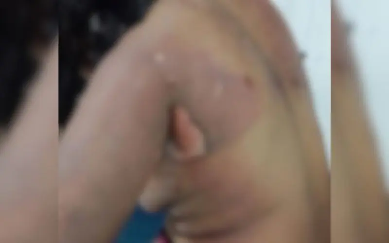 Marido embriagado põe fogo na mulher e filho em Parintins